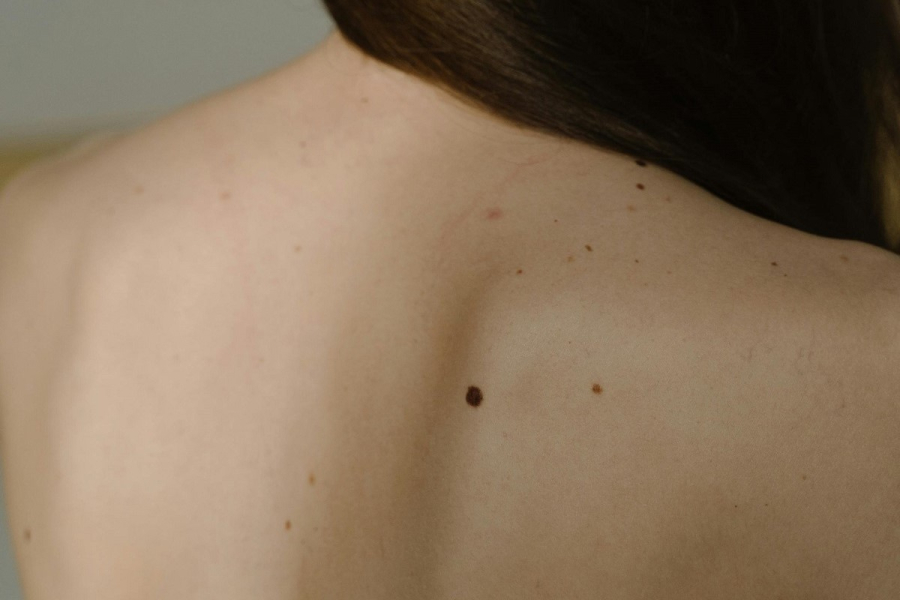 Τα 2 μικρά σημάδια στις ελιές που μπορεί να δείχνουν υποψία καρκίνου