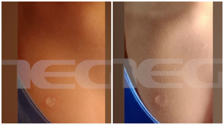 Θεσσαλονίκη: 12χρονη έσβησε τσιγάρο στο στήθος 13χρονης, «έγινε μία παρεξήγηση ανάμεσά τους για ένα αγόρι»