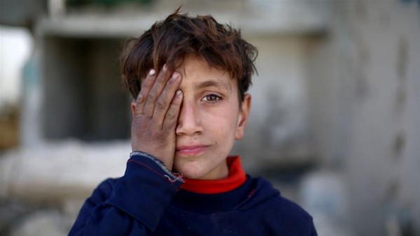 Ο μικρός Σύρος που έχασε το ένα του μάτι σε αεροπορική επιδρομή και αναδείχθηκε σε σύμβολο του πολέμου στο διαδίκτυο
